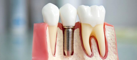 Имплантация