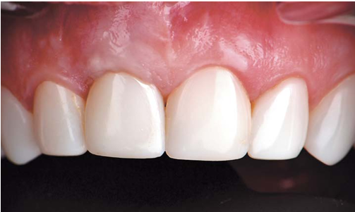 Розовая эстетика в хирургической стоматологии