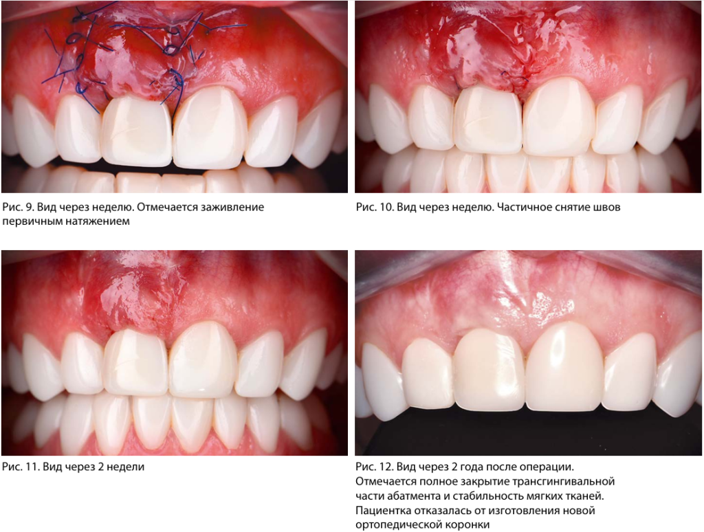 Внешний вид после установки импланта, снятие швов