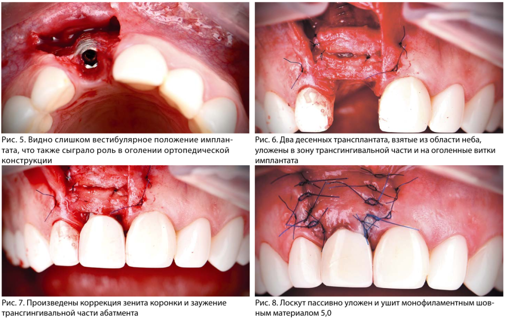 Установка импланта