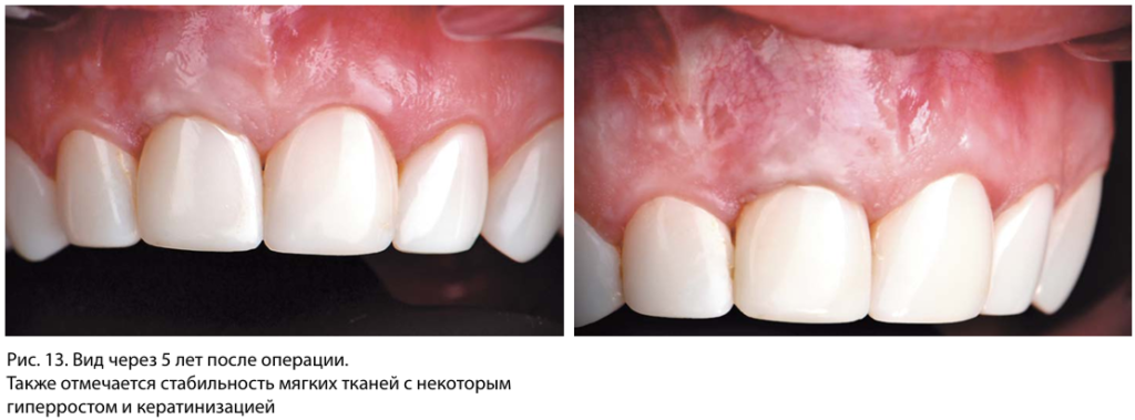 Вид через 5 лет после операции