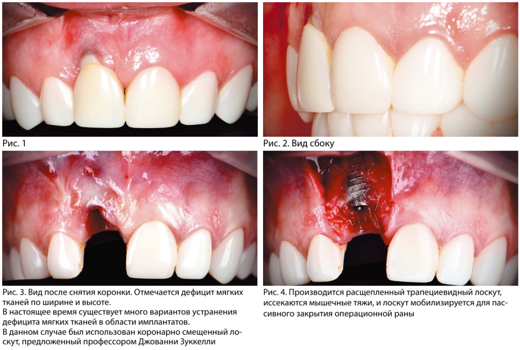 Снятие коронки, закрытие операционной раны 